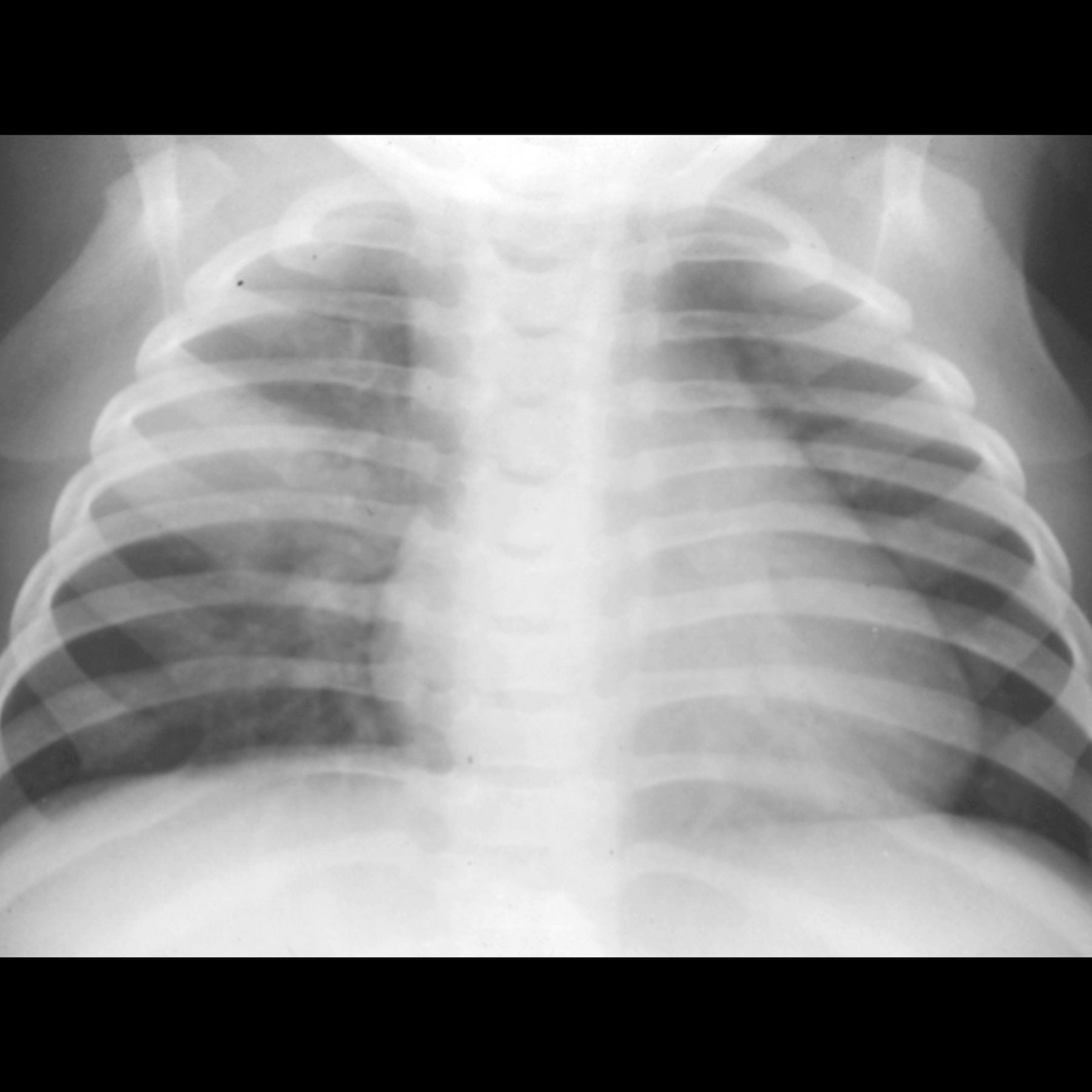 Aspiration pneumonia: A medical condition that is caused by the breathing in of food or liquids into the lungs resulting in an infection.