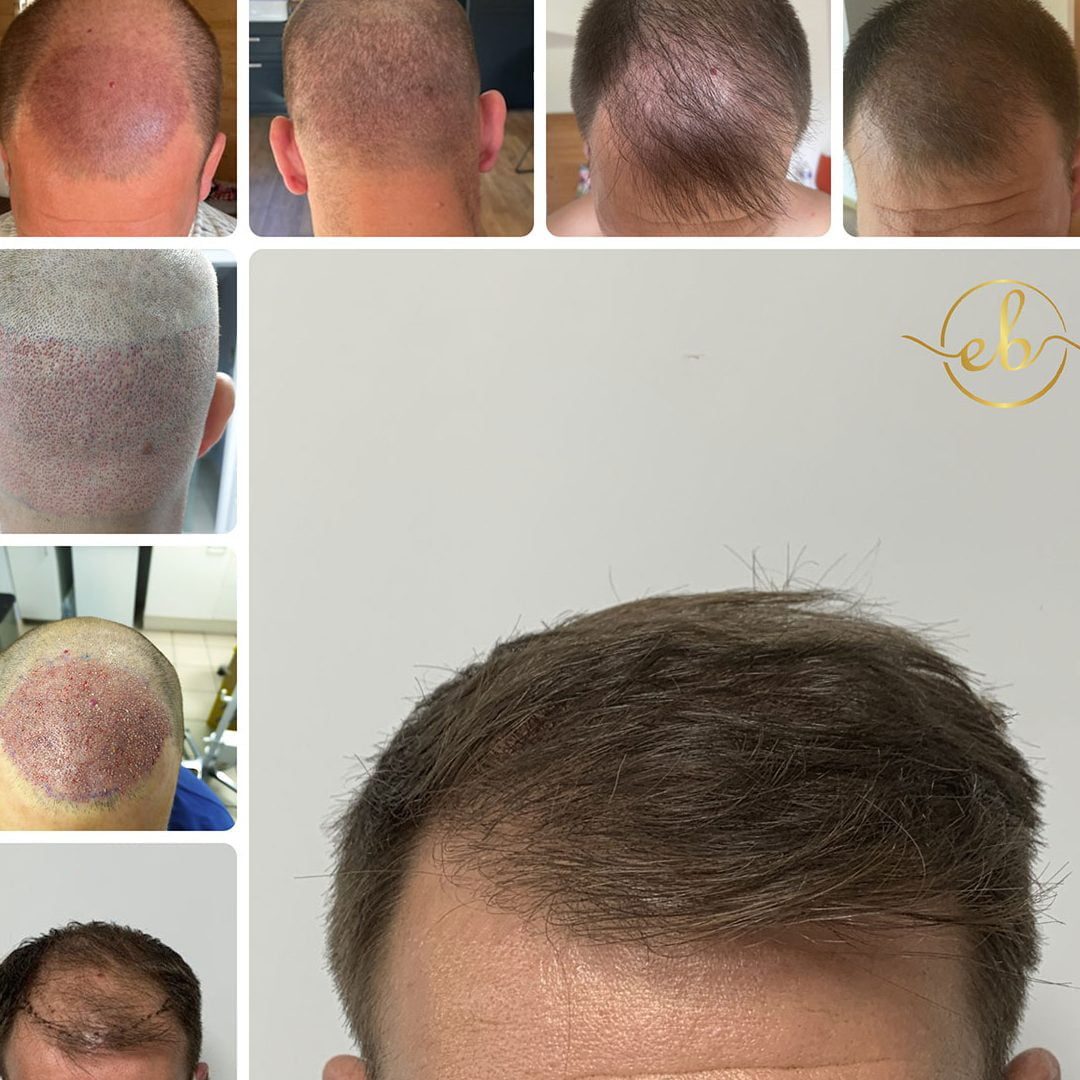 Hair transplantation: An aesthetic procedure where hair is surgically placed onto the head.