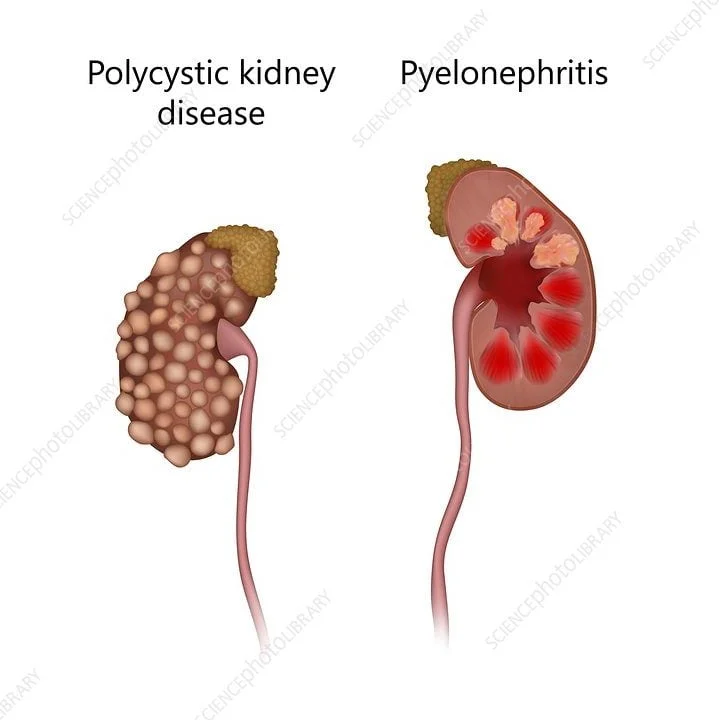 Strive Health: Chronic kidney disease care startup.