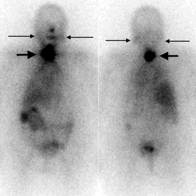 Nodule: A small and abnormal concentration of cells in the body that form a small lump.