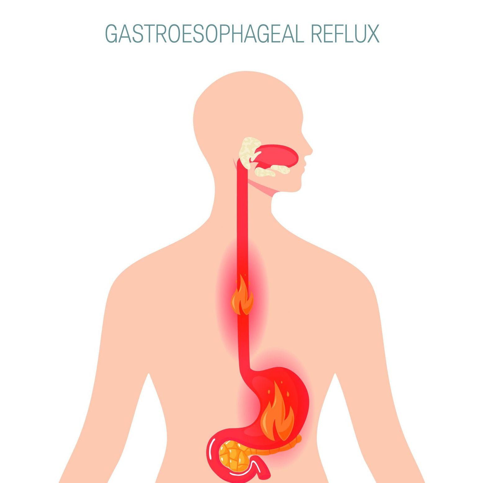 Gastroesophageal reflux disease: The medical term used to describe heartburn and acid reflux symptoms and disorders.